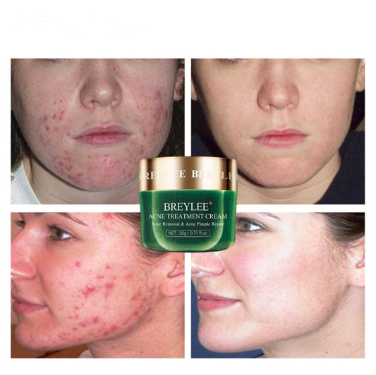 Crème anti-acné hydratante